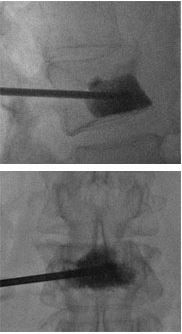 Вертебропластика 2 opuholi pozvonochnika vertebroplastika