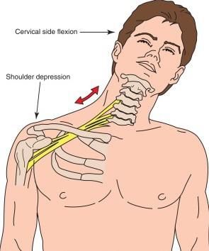 Плексит плечового сплетення 4 100 travma pereferichno n s travma 2