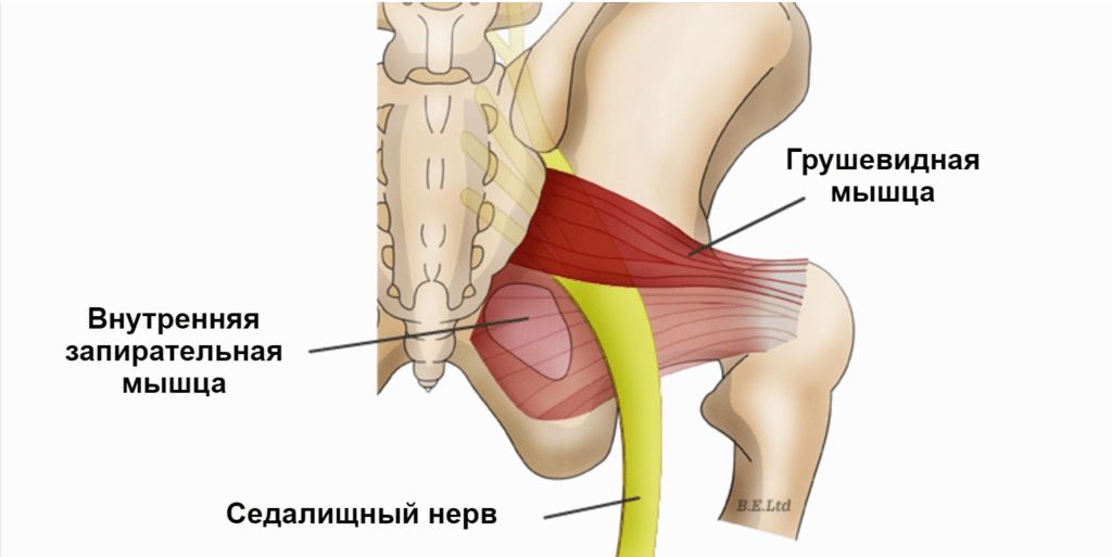 Защемлення сідничного нерва (ішіас) 2 Cиндром грушоподібного м'язу