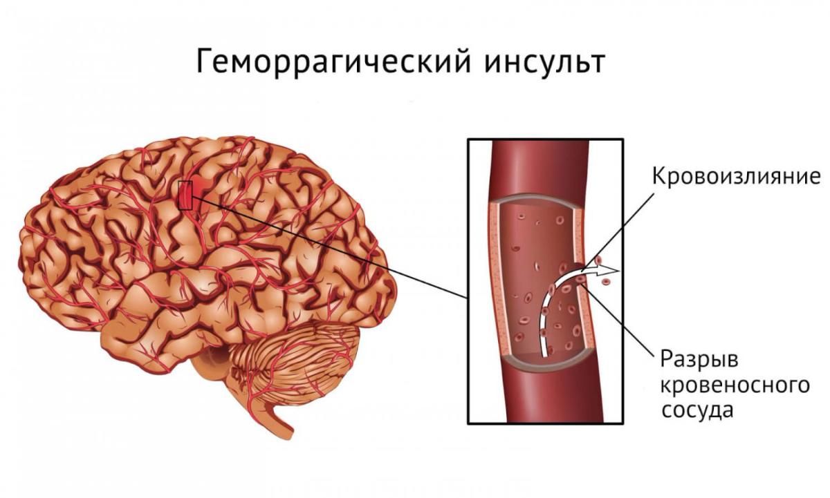 Геморагічний інсульт