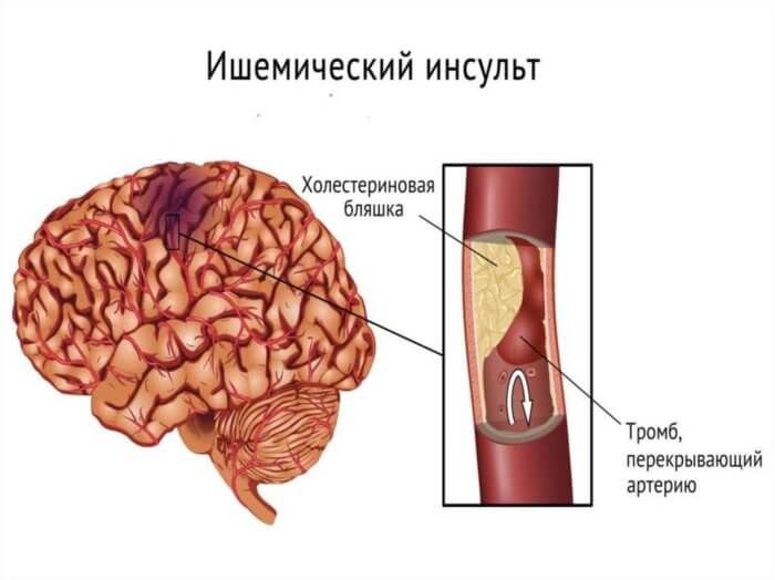 Ішемічний інсульт