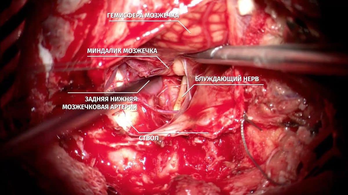 Мікрохірургічне кліпування херсон