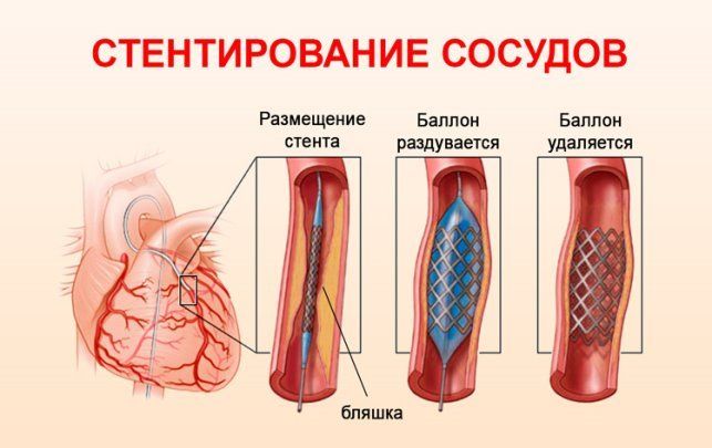 Стентування сонних артерій