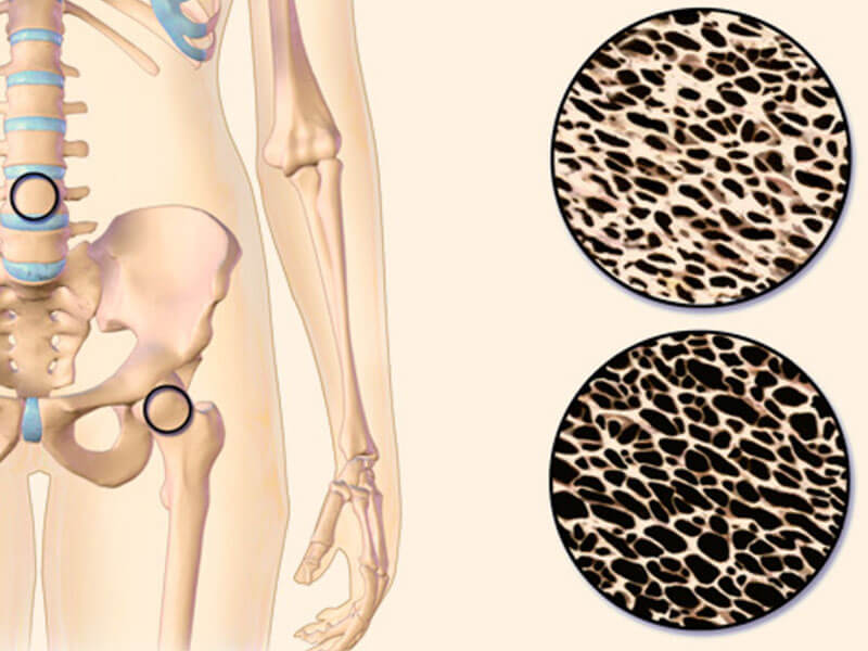 Діагностика судин мозку 3 osteoporoz pozvonochnika 1