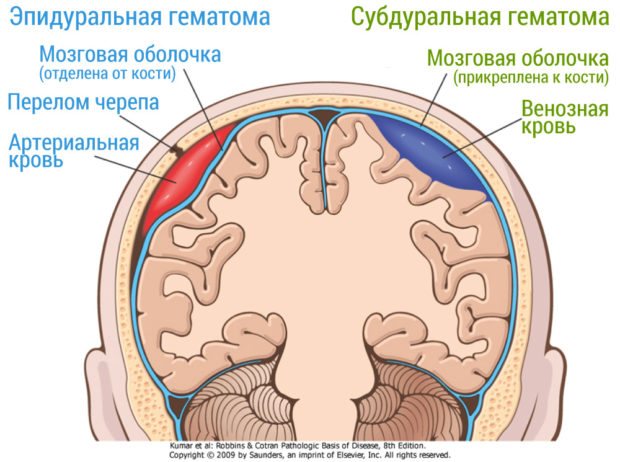 vnutrishnomozkova gematoma
