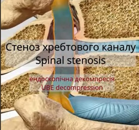 Ендоскопічне лікування стенозу L2–L3 у пацієнтки 75 років (UBE Over-the-Top Decompression)
